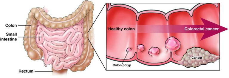 Image from American Gastroenterological Association