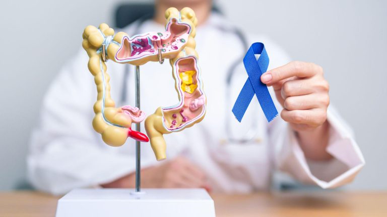 Are You at Risk? Recognising the Silent Symptoms of Colorectal Cancer